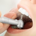 La importancia de la limpieza dental profesional para la salud en general
