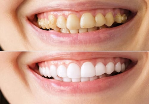 Prevención de caries y caries: consejos para una sonrisa saludable